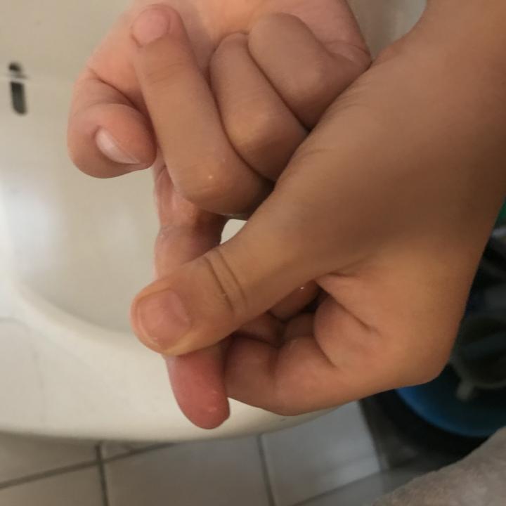 Romeos burned fingertip